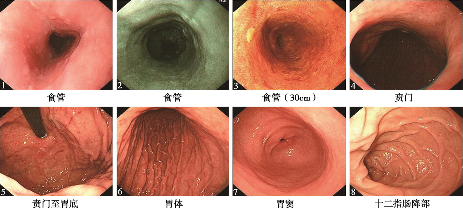 图19 食管黏膜略粗糙，碘染色后可见散在阳性灶